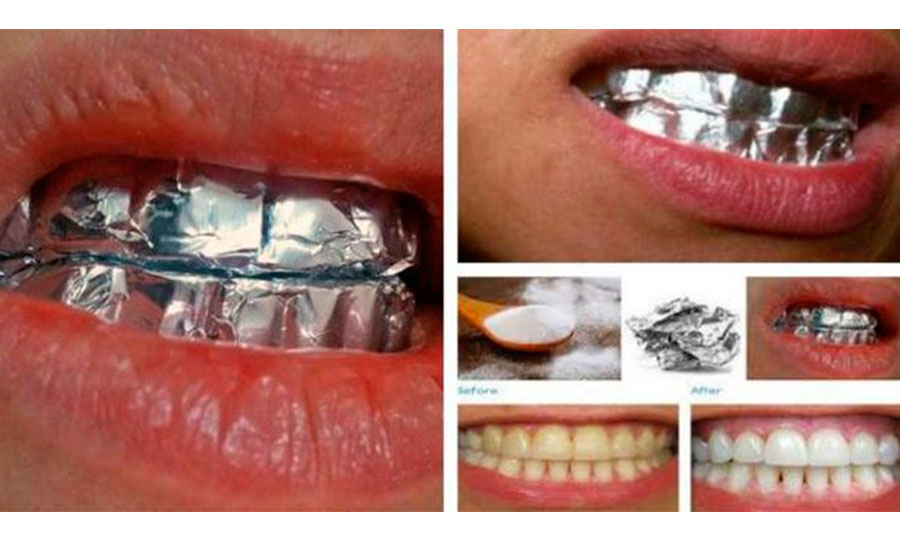 Realmente el papel aluminio blanquea los dientes? | Aweita La República
